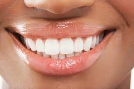 Brightening Your Smile with Teeth Whitening Veneers